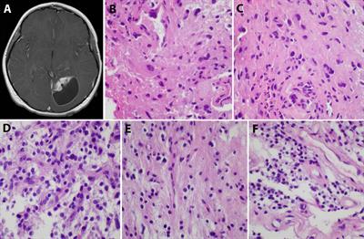 Case report: A unique presentation of a high-grade neuroepithelial tumor with EWSR1::PATZ1 fusion with diagnostic, molecular, and therapeutic insights